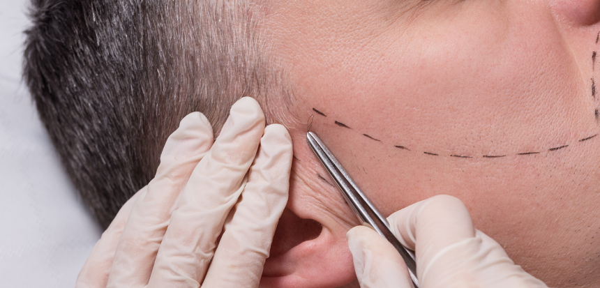 Barttransplantation