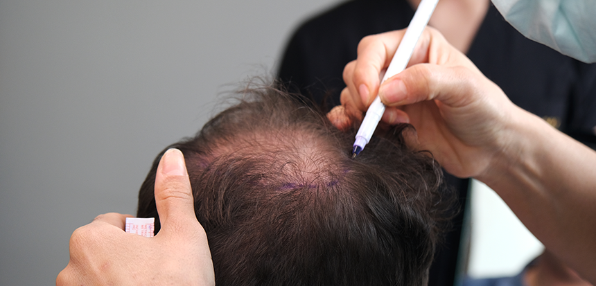 Schmerzlose Haartransplantation