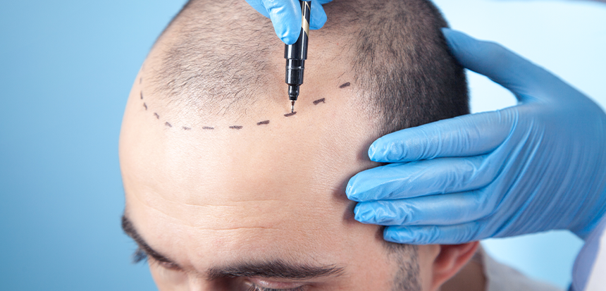  Safir FUE Hair Transplant