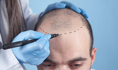 Safir FUE-Haartransplantation