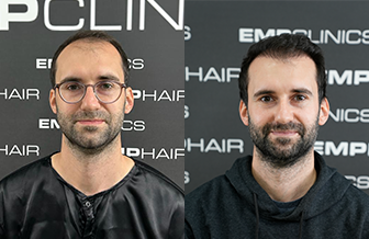Hair Transplant