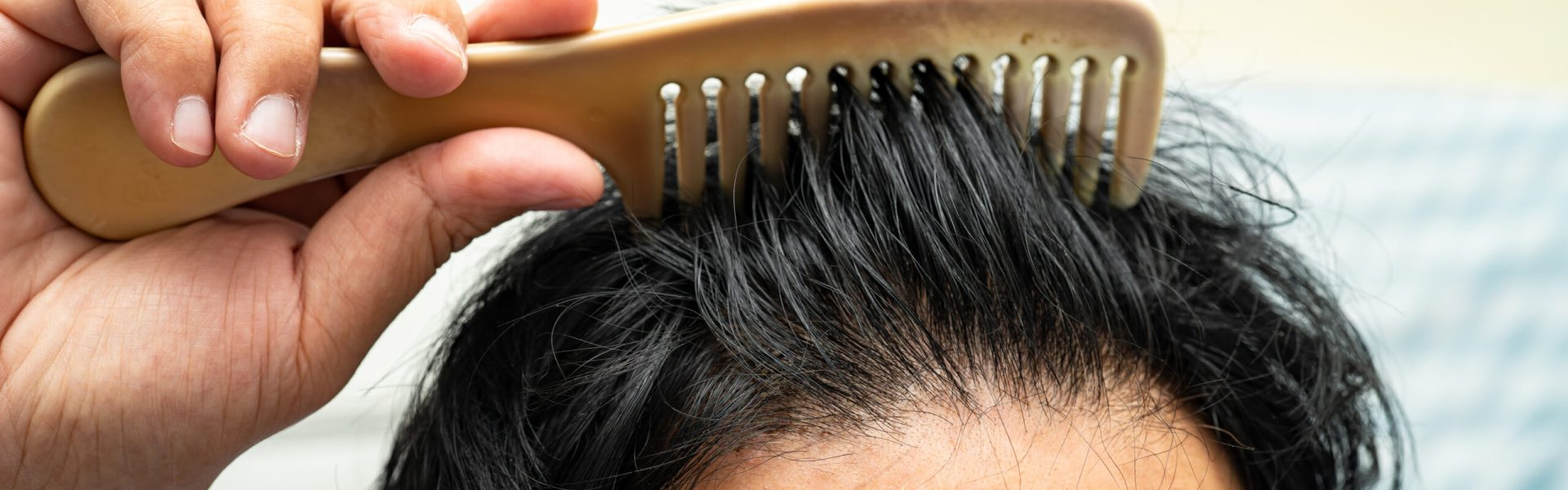 Ventajas y desventajas del trasplante de cabello DHI
