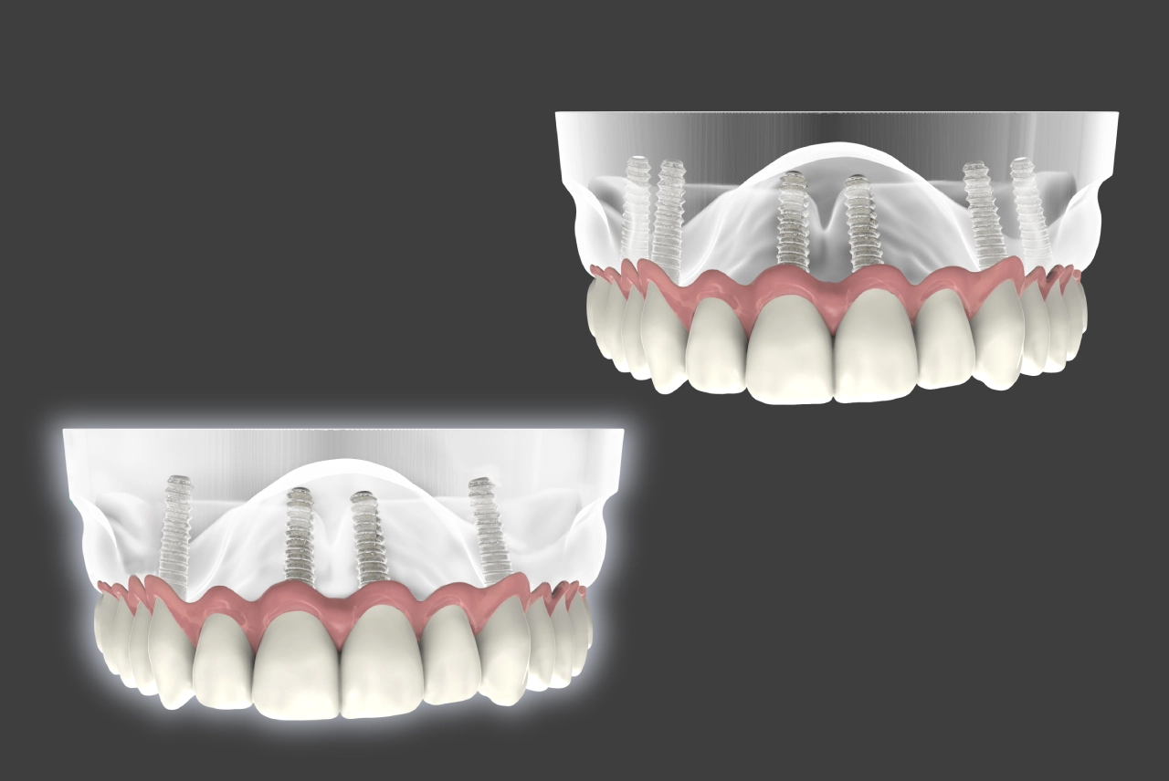 All-on-4 ve All-on-6 İmplant Tedavisi Nedir?