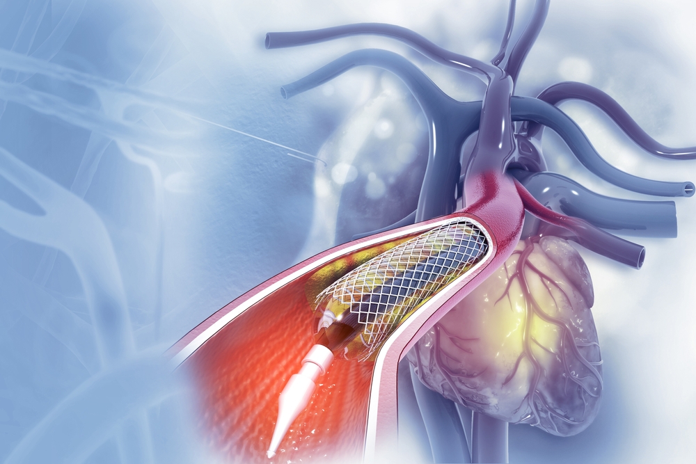 Çift J Stent Takılması ve Çıkarılması 